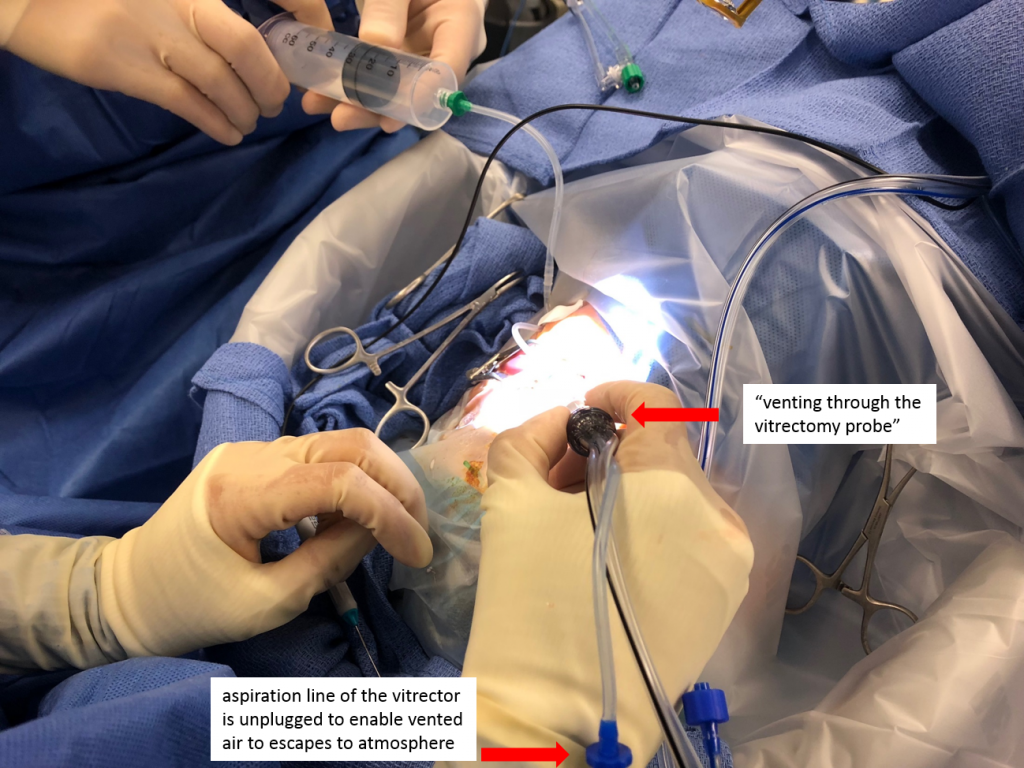 Vitrectomy Basics - Vit Buckle Society