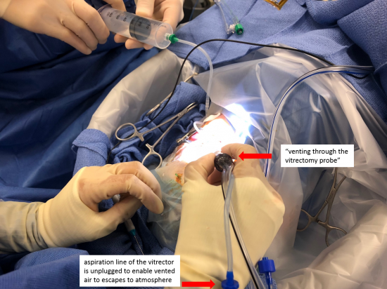 Vitrectomy Basics - Vit Buckle Society